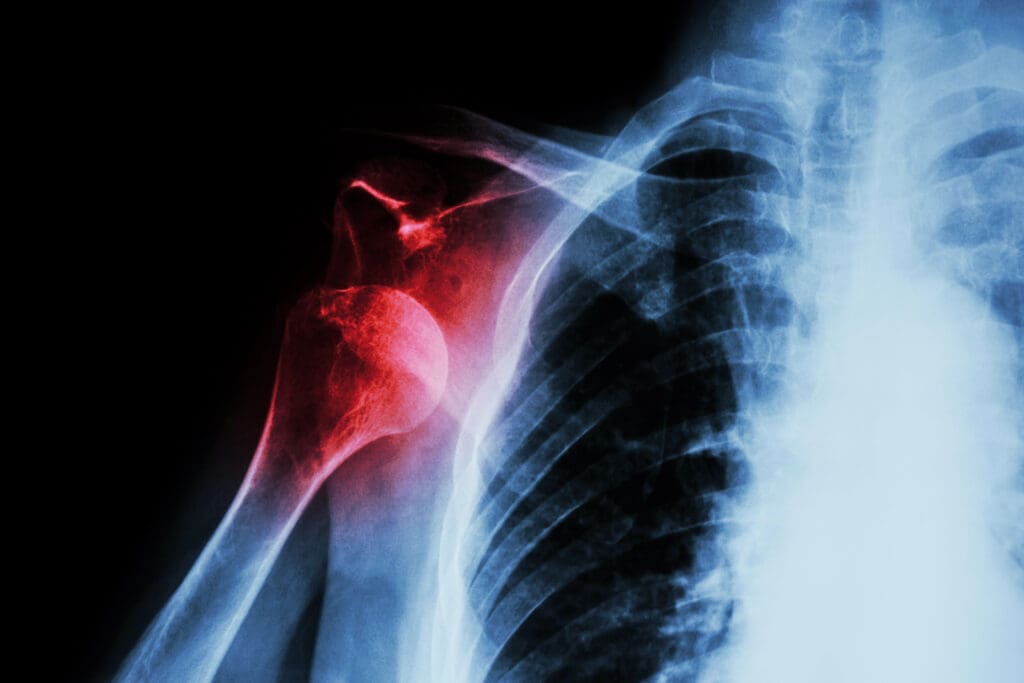 X-ray anterior shoulder dislocation