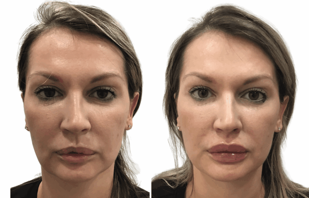 Before and After Picture of a female after Lips Filler