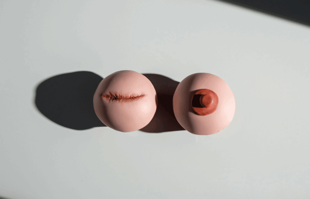 Scarring common after breast surgery